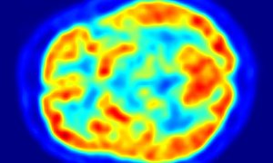Procedura PET CT pomocna w diagnostyce zakażeń związanych z wszczepialnymi układami do elek