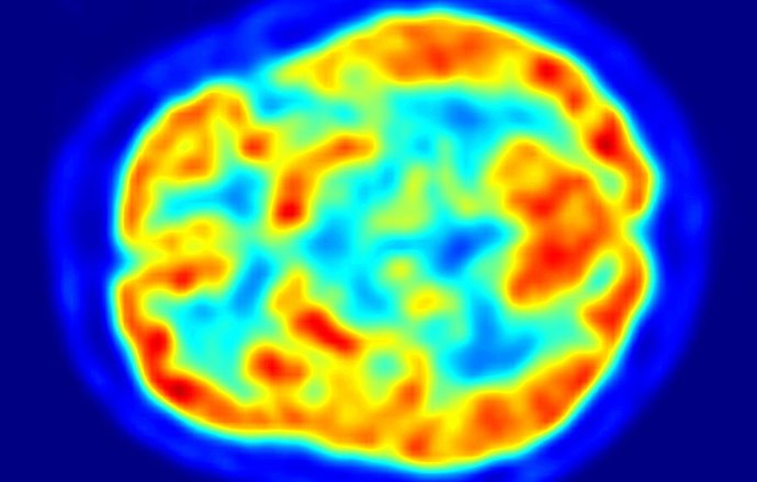 Procedura PET CT pomocna w diagnostyce zakażeń związanych z wszczepialnymi układami do elek