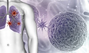 Nowa opcja terapeutyczna dla pacjentów z rakiem płuca
