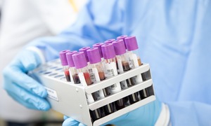 Potencjał terapeutyczny celowania w inhibitor aktywatora plazminogenu w leczeniu COVID-19