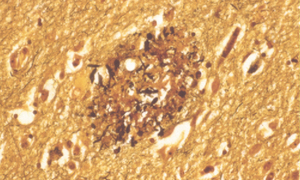 FDA zatwierdziła nowy lek na chorobę Alzheimera. Pierwszy od 18 lat