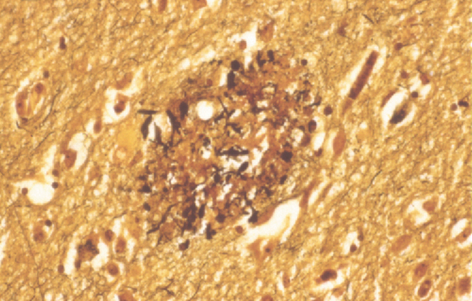 FDA zatwierdziła nowy lek na chorobę Alzheimera. Pierwszy od 18 lat