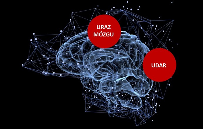 EpiFix –  przełomowe rozwiązanie terapeutyczne chroniące przed rozwojem padaczki pourazowej