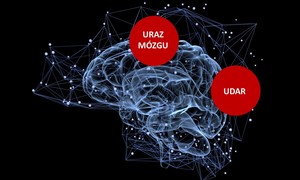 EpiFix –  przełomowe rozwiązanie terapeutyczne chroniące przed rozwojem padaczki pourazowej
