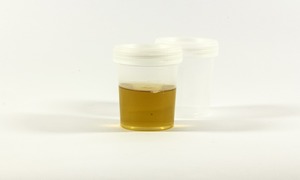 Wysokie parametry czułości i swoistości testów diagnostycznych Urteste na raka trzustki
