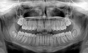 RTG punktowe, cefalometria, pantomografia – czyli cyfryzacja w stomatologii