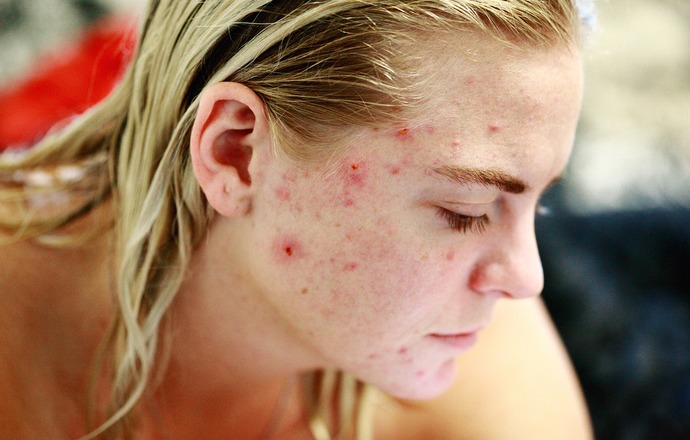 Demodex – czy znaleźliśmy winowajcę trądziku różowatego?