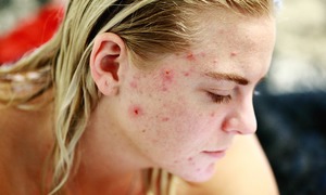 Demodex – czy znaleźliśmy winowajcę trądziku różowatego?