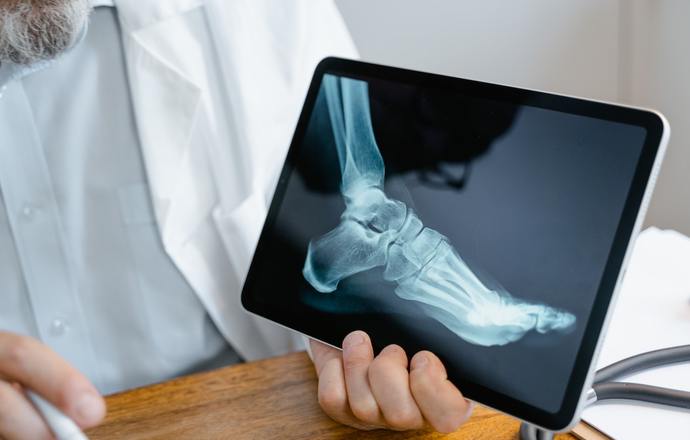 Szansa na przełom w leczeniu osteoporozy – groźnej i podstępnej choroby kości