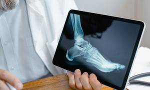 Szansa na przełom w leczeniu osteoporozy – groźnej i podstępnej choroby kości