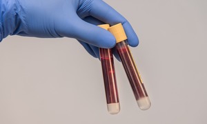 Eksperci dostrzegają wzrost świadomości, ale w walce z HCV pozostaje wiele do zrobienia