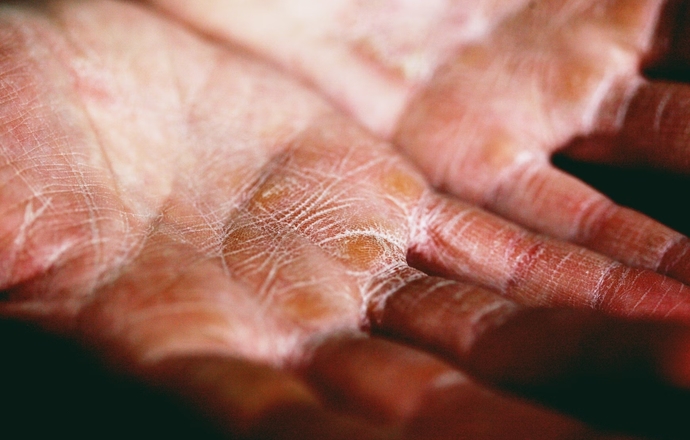 Genodermatozy – rzadkie choroby o podłożu genetycznym