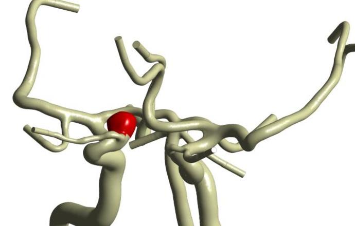 Polskie oprogramowanie wesprze neurochirurgów w leczeniu tętniaków