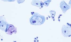 Cytologia LBC to większa wiarygodność badania, skuteczniejsza profilaktyka i leczenie