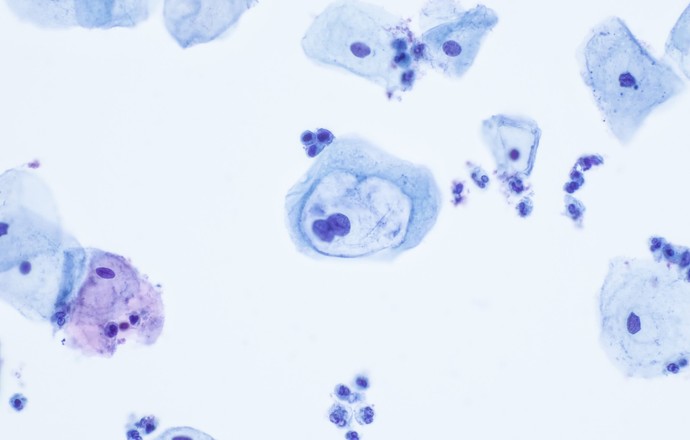 Cytologia LBC to większa wiarygodność badania, skuteczniejsza profilaktyka i leczenie
