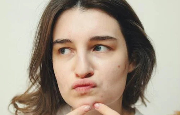 Dermatillomania – coraz częstsze zaburzenie obsesyjno-kompulsyjne