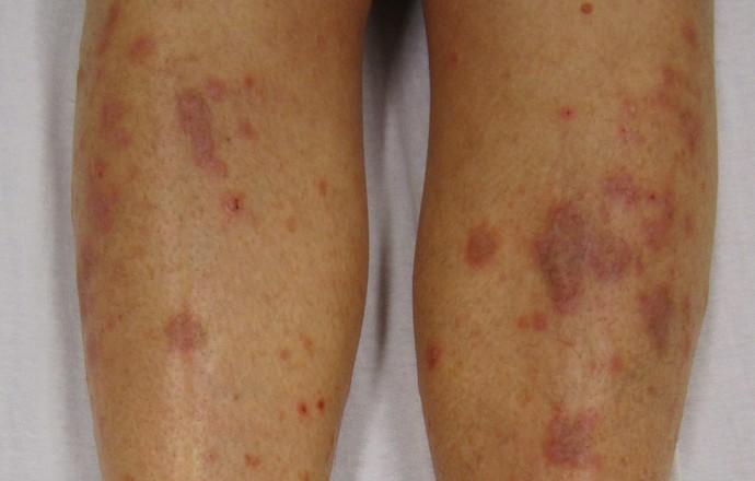 Rzadkie dermatozy o podłożu autoimmunologicznym – pęcherzyca skóry i liszaj płaski